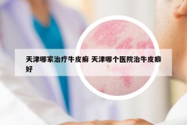 天津哪家治療牛皮癬 天津哪個醫(yī)院治牛皮癖好