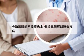 卡泊三醇能不能擦頭上 卡泊三醇可以擦頭皮嗎