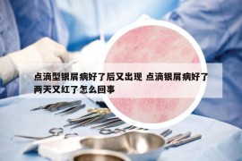 點(diǎn)滴型銀屑病好了后又出現(xiàn) 點(diǎn)滴銀屑病好了兩天又紅了怎么回事