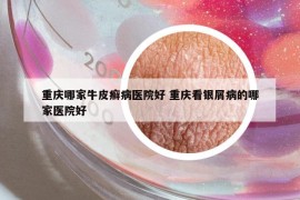重慶哪家牛皮癬病醫(yī)院好 重慶看銀屑病的哪家醫(yī)院好