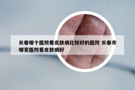 長春哪個醫(yī)院看皮膚病比較好的醫(yī)院 長春市哪家醫(yī)院看皮膚病好