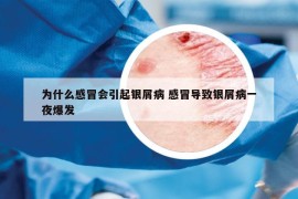 為什么感冒會引起銀屑病 感冒導(dǎo)致銀屑病一夜爆發(fā)