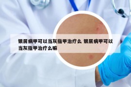 銀屑病甲可以當(dāng)灰指甲治療么 銀屑病甲可以當(dāng)灰指甲治療么嘛
