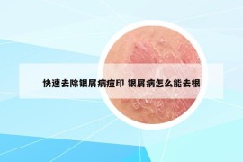 快速去除銀屑病痘印 銀屑病怎么能去根