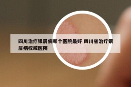 四川治療銀屑病哪個醫(yī)院最好 四川省治療銀屑病權(quán)威醫(yī)院