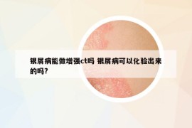 銀屑病能做增強(qiáng)ct嗎 銀屑病可以化驗(yàn)出來的嗎?
