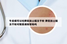 牛皮癬可以吃脾氨肽口服凍干粉 脾氨肽口服凍干粉對(duì)銀屑病有幫助嗎