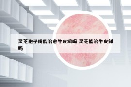 靈芝孢子粉能治愈牛皮癬嗎 靈芝能治牛皮鮮嗎