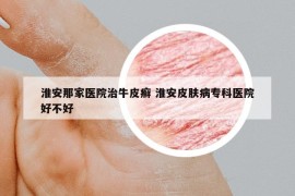 淮安那家醫(yī)院治牛皮癬 淮安皮膚病專科醫(yī)院好不好