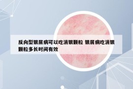 反向型銀屑病可以吃消銀顆粒 銀屑病吃消銀顆粒多長(zhǎng)時(shí)間有效