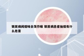 銀屑病聞煙味會發(fā)作嘛 銀屑病患者抽煙有什么危害