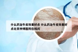 什么藥治牛皮效果好點(diǎn) 什么藥治牛皮效果好點(diǎn)北京仲博醫(yī)院在線問