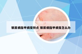 銀屑病指甲病變特點 銀屑病指甲病變怎么辦