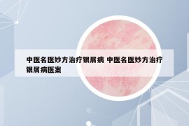 中醫(yī)名醫(yī)妙方治療銀屑病 中醫(yī)名醫(yī)妙方治療銀屑病醫(yī)案