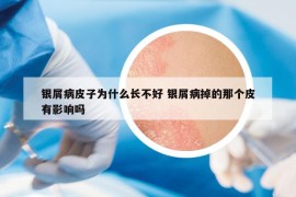 銀屑病皮子為什么長(zhǎng)不好 銀屑病掉的那個(gè)皮有影響嗎