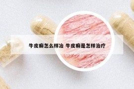牛皮癬怎么樣冶 牛皮癬是怎樣治療