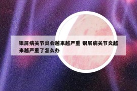 銀屑病關(guān)節(jié)炎會(huì)越來(lái)越嚴(yán)重 銀屑病關(guān)節(jié)炎越來(lái)越嚴(yán)重了怎么辦