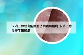 卡泊三醇軟膏能擦臉上的銀屑病嗎 卡泊三醇治好了銀屑病
