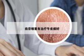 南京哪里有治療牛皮癬好