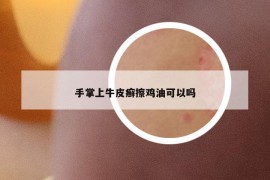 手掌上牛皮癬擦雞油可以嗎
