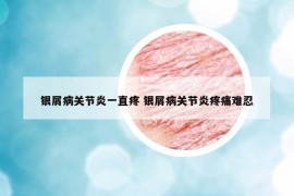 銀屑病關節(jié)炎一直疼 銀屑病關節(jié)炎疼痛難忍
