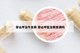 穿山甲治牛皮癬 穿山甲能治銀屑病嗎
