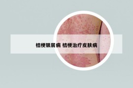 桔梗銀屑病 桔梗治療皮膚病
