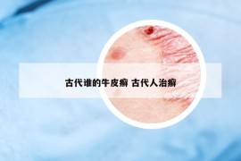 古代誰的牛皮癬 古代人治癬