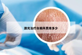 激光治療白癜風(fēng)費用多少