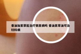 香油加紫草能治療銀屑病嗎 香油紫草油可治婦科病