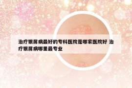 治療銀屑病最好的?？漆t(yī)院是哪家醫(yī)院好 治療銀屑病哪里最專業(yè)