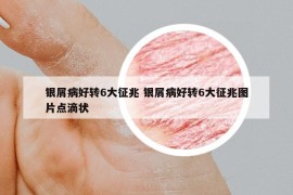 銀屑病好轉(zhuǎn)6大征兆 銀屑病好轉(zhuǎn)6大征兆圖片點(diǎn)滴狀