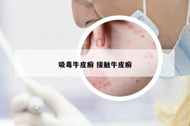 吸毒牛皮癬 接觸牛皮癬