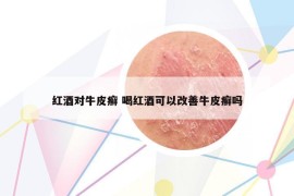 紅酒對(duì)牛皮癬 喝紅酒可以改善牛皮癬嗎