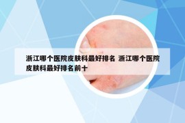 浙江哪個(gè)醫(yī)院皮膚科最好排名 浙江哪個(gè)醫(yī)院皮膚科最好排名前十