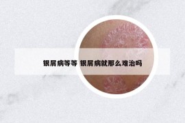 銀屑病等等 銀屑病就那么難治嗎