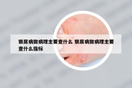 銀屑病做病理主要查什么 銀屑病做病理主要查什么指標