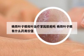 楊鐵葉子根和葉治療掌跖膿皰嗎 楊鐵葉子根有什么藥用價值
