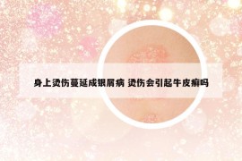 身上燙傷蔓延成銀屑病 燙傷會(huì)引起牛皮癬嗎