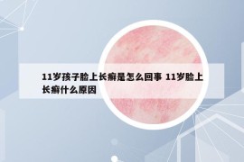 11歲孩子臉上長癬是怎么回事 11歲臉上長癬什么原因