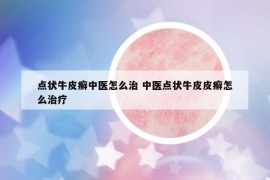 點(diǎn)狀牛皮癬中醫(yī)怎么治 中醫(yī)點(diǎn)狀牛皮皮癬怎么治療