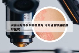 河南治療牛皮癬哪里最好 河南省治銀屑病最好醫(yī)院