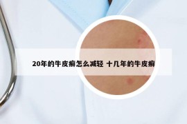 20年的牛皮癬怎么減輕 十幾年的牛皮癬