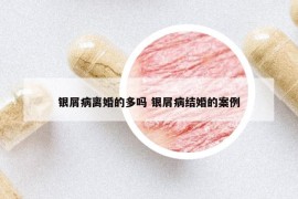 銀屑病離婚的多嗎 銀屑病結(jié)婚的案例