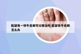 臉部有一塊牛皮癬可以根治嗎 臉部有牛皮癬怎么辦