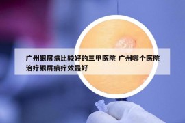 廣州銀屑病比較好的三甲醫(yī)院 廣州哪個醫(yī)院治療銀屑病療效最好
