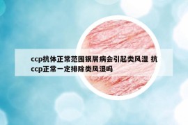 ccp抗體正常范圍銀屑病會(huì)引起類風(fēng)濕 抗ccp正常一定排除類風(fēng)濕嗎