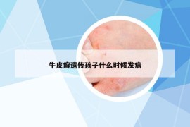 牛皮癬遺傳孩子什么時(shí)候發(fā)病
