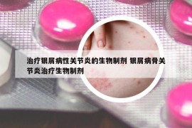 治療銀屑病性關節(jié)炎的生物制劑 銀屑病骨關節(jié)炎治療生物制劑