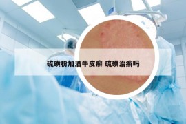 硫磺粉加酒牛皮癬 硫磺治癬嗎
